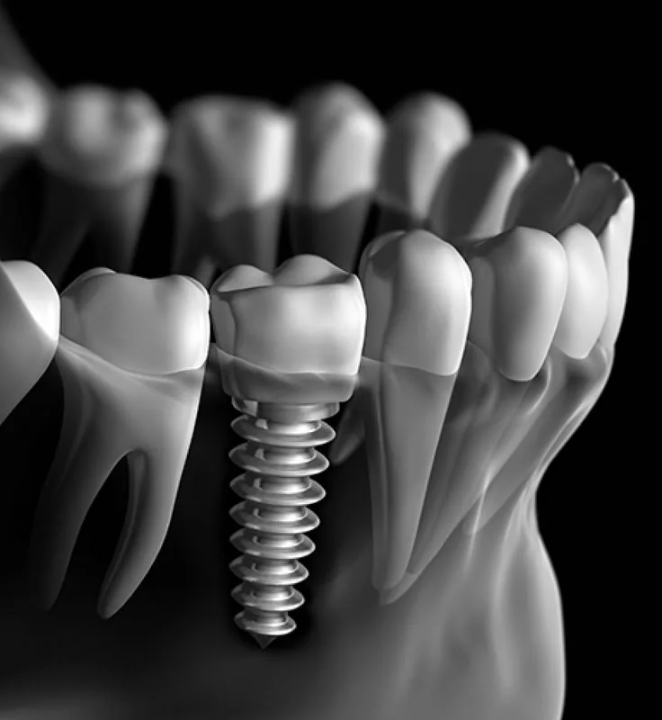 Dental Implants at DentiQ